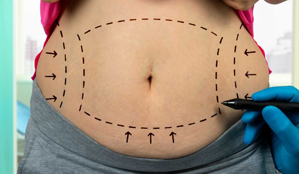 Belly liposuction When will the results appear