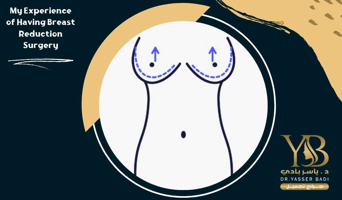 My Experience of Having Breast Reduction Surgery