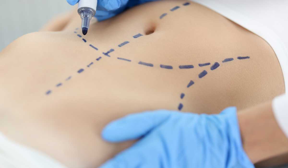 My experience with tummy tuck surgery