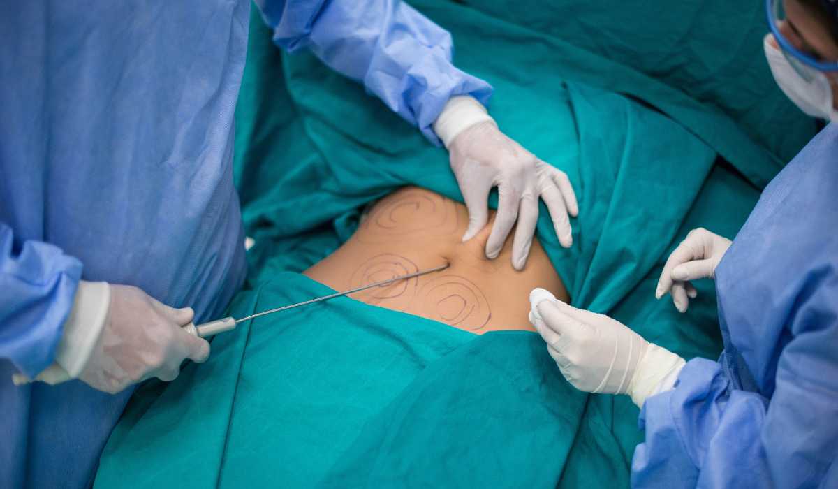 Liposuction Procedure Steps