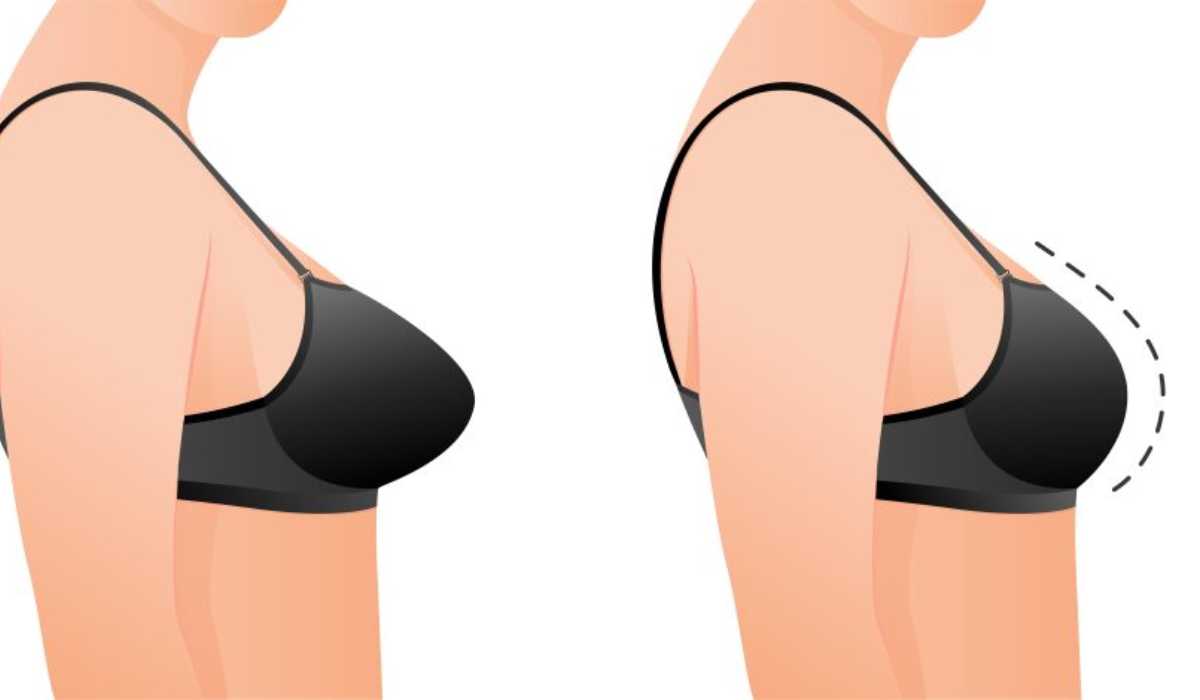 What to expect after breast reduction surgery