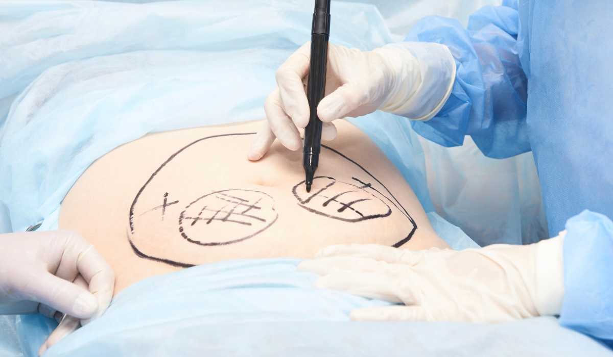 Best plastic surgeon in Egypt for liposuction