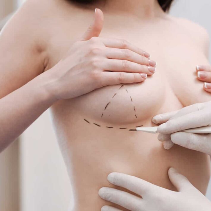 what-things-to-consider-before-undergoing-breast-augmentation-surgery